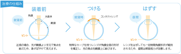 レンズ装着前、装着中、脱着後のイメージ